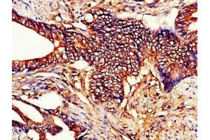 IHC image of ABIN7149184 diluted at 1:200 and staining in paraffin-embedded human colon cancer performed on a Leica BondTM system. (Cytochrome C 抗体  (AA 2-105))