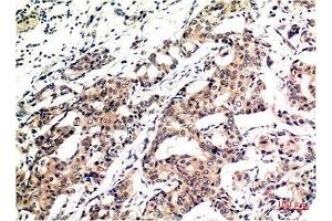 Immunohistochemical analysis of paraffin-embedded Human Breast Carcinoma Tissue using Ubiquitin Mouse mAb diluted at 1:200. (Ubiquitin 抗体)