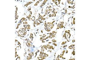 Immunohistochemistry of paraffin-embedded human breast cancer using Lamin A/C Rabbit pAb (ABIN6133798 and ABIN6143078) at dilution of 1:150 (40x lens). (Lamin A/C 抗体)