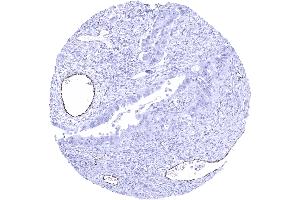 Ovary Serous high grade carcinoma showing distinct endothelial vWF staining in a subset of intratumoral vessels (Recombinant VWF 抗体  (AA 1815-1939))