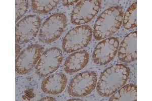 IHC analysis (400X) of CK19 expression in colon cancer, using CK19 antibody (1:1000 dilution). (Cytokeratin 19 抗体  (full length))
