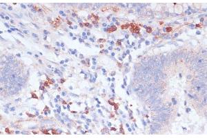 Immunohistochemistry of paraffin-embedded Human colon carcinoma using VASP Polyclonal Antibody at dilution of 1:100 (40x lens). (VASP 抗体)