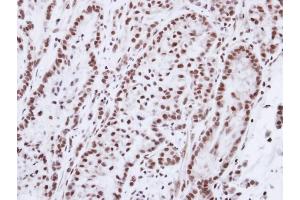 Immunohistochemical staining of paraffin-embedded A549 xenograft using Progesterone receptor antibody at a dilution of 1:100 (Progesterone Receptor 抗体)