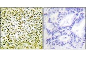 Immunohistochemistry analysis of paraffin-embedded human lung carcinoma tissue, using p53 (Ab-317) Antibody. (p53 抗体  (AA 283-332))