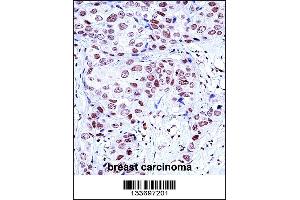 NCK1 Antibody immunohistochemistry analysis in formalin fixed and paraffin embedded human breast carcinoma followed by peroxidase conjugation of the secondary antibody and DAB staining. (NCK1 抗体  (N-Term))