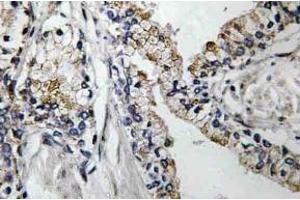 Immunohistochemistry (IHC) analyzes of VDR antibody in paraffin-embedded human prostate carcinoma tissue. (Claudin 7 抗体)