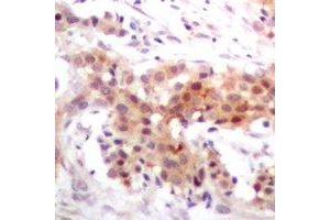 Immunohistochemical analysis of p300 staining in human breast cancer formalin fixed paraffin embedded tissue section. (p300 抗体)