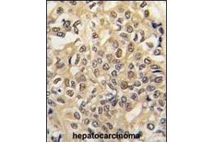 Formalin-fixed and paraffin-embedded human hepatocarcinoma tissue reacted with UBE1 antibody (C-term) (ABIN388844 and ABIN2839150) , which was peroxidase-conjugated to the secondary antibody, followed by DAB staining. (E1 Ubiquitin (AA 1026-1058), (C-Term) 抗体)