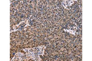 Immunohistochemistry of Human ovarian cancer using EVC2 Polyclonal Antibody at dilution of 1:40 (EVC2 抗体)