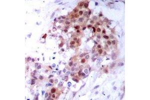 Immunohistochemical analysis of p38 staining in human breast cancer formalin fixed paraffin embedded tissue section. (MAPK14 抗体)