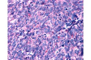 Anti-HTR1B / 5-HT2B Receptor antibody IHC of human Lung, Small Cell Carcinoma. (Serotonin Receptor 2B 抗体  (N-Term))