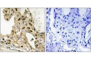 Immunohistochemistry analysis of paraffin-embedded human breast carcinoma, using p53 (Phospho-Thr387) Antibody. (p53 抗体  (pThr387))