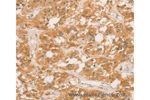 Immunohistochemistry of Human gastric cancer using CPB1 Polyclonal Antibody at dilution of 1:60 (CPB1 抗体)