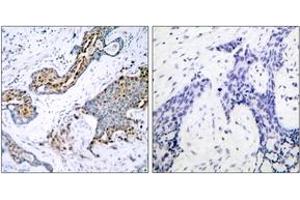 Immunohistochemistry analysis of paraffin-embedded human breast carcinoma, using Estrogen Receptor-alpha (Phospho-Ser118) Antibody. (Estrogen Receptor alpha 抗体  (pSer118))