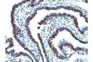 Formalin-fixed, paraffin-embedded human ovarian carcinoma stained with Histone H1 antibody (AE-4) (Histone 抗体)