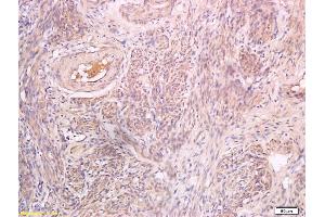 Formalin-fixed and paraffin embedded human endometrial carcinoma labeled with Anti-Inhibin beta B Polyclonal Antibody, Unconjugated (ABIN734993) at 1:200 followed by conjugation to the secondary antibody and DAB staining (Pro-Inhibin beta B (AA 251-350) 抗体)