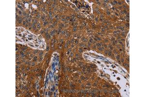 Immunohistochemistry of Human lung cancer using JUP Polyclonal Antibody at dilution of 1:40 (JUP 抗体)