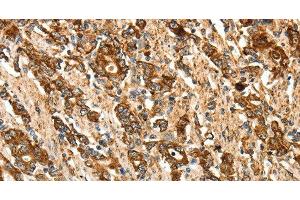 Immunohistochemistry of paraffin-embedded Human gastic cancer using CALR Polyclonal Antibody at dilution of 1:50 (Calreticulin 抗体)