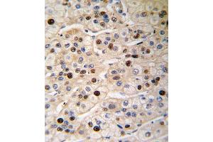 Formalin-fixed and paraffin-embedded human hepatocarcinoma tissue reacted with PCNA antibody , which was peroxidase-conjugated to the secondary antibody, followed by DAB staining. (PCNA 抗体  (AA 89-117))
