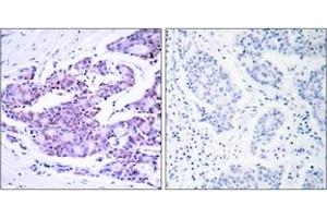Immunohistochemistry analysis of paraffin-embedded human breast carcinoma tissue, using NF-kappaB p65 (Ab-468) Antibody. (NF-kB p65 抗体  (AA 435-484))