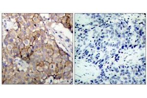 Immunohistochemical analysis of paraffin-embedded human breast carcinoma tissue using (EGFR 抗体)