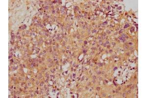 IHC image of ABIN7171217 diluted at 1:500 and staining in paraffin-embedded human ovarian cancer performed on a Leica BondTM system. (STX1A 抗体  (AA 1-179))
