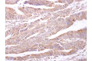 IHC-P Image PTP1B antibody [N1N3] detects PTP1B protein at cytosol on human colon carcinoma by immunohistochemical analysis. (PTPN1 抗体)