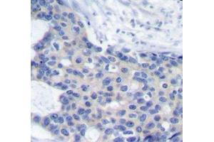 Immunohistochemistry of paraffin-embedded Human breast carcinoma tissue, using Phospho-ZAP70(Y493) Polyclonal Antibody (ZAP70 抗体  (pTyr493))