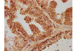 IHC image of ABIN7172814 diluted at 1:600 and staining in paraffin-embedded human prostate cancer performed on a Leica BondTM system. (TGFB1 抗体  (AA 281-390))