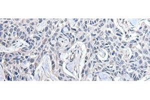 Immunohistochemistry of paraffin-embedded Human lung cancer tissue using PPIG Polyclonal Antibody at dilution of 1:50(x200) (PPIG 抗体)