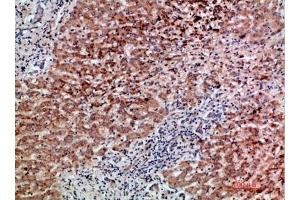 Immunohistochemical analysis of paraffin-embedded human-liver-cancer, antibody was diluted at 1:200. (GDF2 抗体  (AA 371-420))