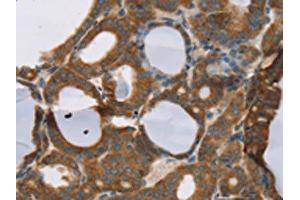 The image on the left is immunohistochemistry of paraffin-embedded Human thyroid cancer tissue using ABIN7192209(RORB Antibody) at dilution 1/30, on the right is treated with synthetic peptide. (RORB 抗体)