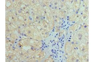Immunohistochemistry of paraffin-embedded human liver cancer using ABIN7155441 at dilution of 1:100 (HIST1H4A 抗体  (AA 2-50))