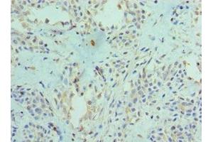 Immunohistochemistry of paraffin-embedded human breast cancer using ABIN7166400 at dilution of 1:100 (PAD4 抗体  (AA 1-250))