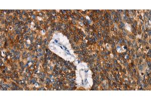 Immunohistochemistry of paraffin-embedded Human lung cancer tissue using CD68 Polyclonal Antibody at dilution 1:30 (CD68 抗体)