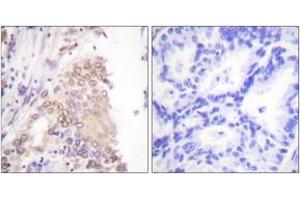 Immunohistochemistry analysis of paraffin-embedded human lung carcinoma tissue, using AML1 (Ab-276) Antibody. (RUNX1 抗体  (AA 242-291))
