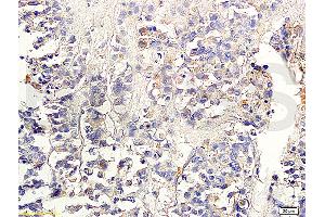 Formalin-fixed and paraffin embedded human colon carcinoma labeled with Anti-TGF-beta-2 Polyclonal Antibody, Unconjugated (ABIN724880) 1:300 followed by conjugation to the secondary antibody and DAB staining (TGF beta 2 Propeptide (AA 154-197) 抗体)