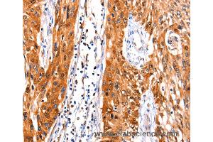 Immunohistochemistry of Human liver cancer using FBLN1 Polyclonal Antibody at dilution of 1:47 (Fibulin 1 抗体)