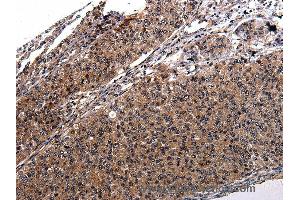 Immunohistochemistry of Human renal cancer using RAB41 Polyclonal Antibody at dilution of 1:100 (RAB41 抗体)