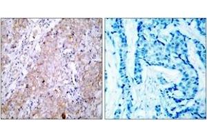 Immunohistochemistry analysis of paraffin-embedded human breast carcinoma tissue, using EGFR (Ab-1070) Antibody. (EGFR 抗体  (AA 1041-1090))