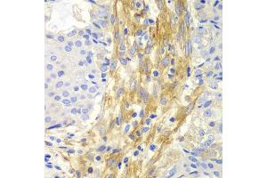 Immunohistochemistry of paraffin-embedded human oophoroma using FLNA antibody at dilution of 1:100 (400x lens). (Filamin A 抗体)