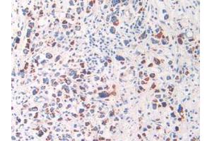 IHC-P analysis of Human Stomach Cancer Tissue, with DAB staining. (HSPD1 抗体  (AA 172-343))