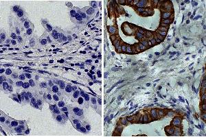 Paraffin embedded human gastric cancer tissue was stained with Mouse IgG2a-HRP isotype control followed by DAB and hematoxylin. (Cytokeratin 19 抗体  (C-Term))