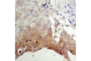 Immunohistochemical analysis of TSC2 staining in human prostate cancer formalin fixed paraffin embedded tissue section. (Tuberin 抗体)