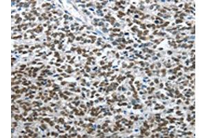 The image on the left is immunohistochemistry of paraffin-embedded Human ovarian cancer tissue using ABIN7128510(ARL2 Antibody) at dilution 1/15, on the right is treated with fusion protein. (ARL2 抗体)