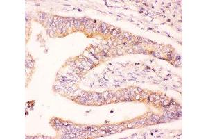 IHC-P: MCL1 antibody testing of human intestine cancer tissue (MCL-1 抗体  (AA 1-350))