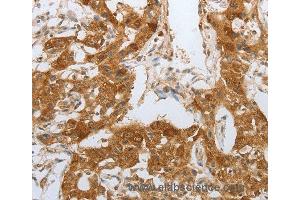 Immunohistochemistry of Human lung cancer using NPY1R Polyclonal Antibody at dilution of 1:25 (NPY1R 抗体)