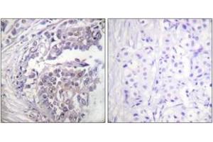 Immunohistochemistry analysis of paraffin-embedded human breast carcinoma tissue, using Histone H2B (Acetyl-Lys5) Antibody. (Histone H2B 抗体  (acLys5))