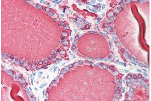 Human Thyroid (formalin-fixed, paraffin-embedded) stained with TG antibody ABIN214384 at 5 ug/ml followed by biotinylated anti-mouse IgG secondary antibody ABIN481714, alkaline phosphatase-streptavidin and chromogen. (Thyroglobulin 抗体)