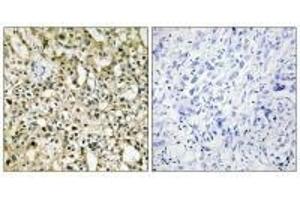 Immunohistochemistry analysis of paraffin-embedded human liver carcinoma tissue using Myc antibody. (c-MYC 抗体  (C-Term))